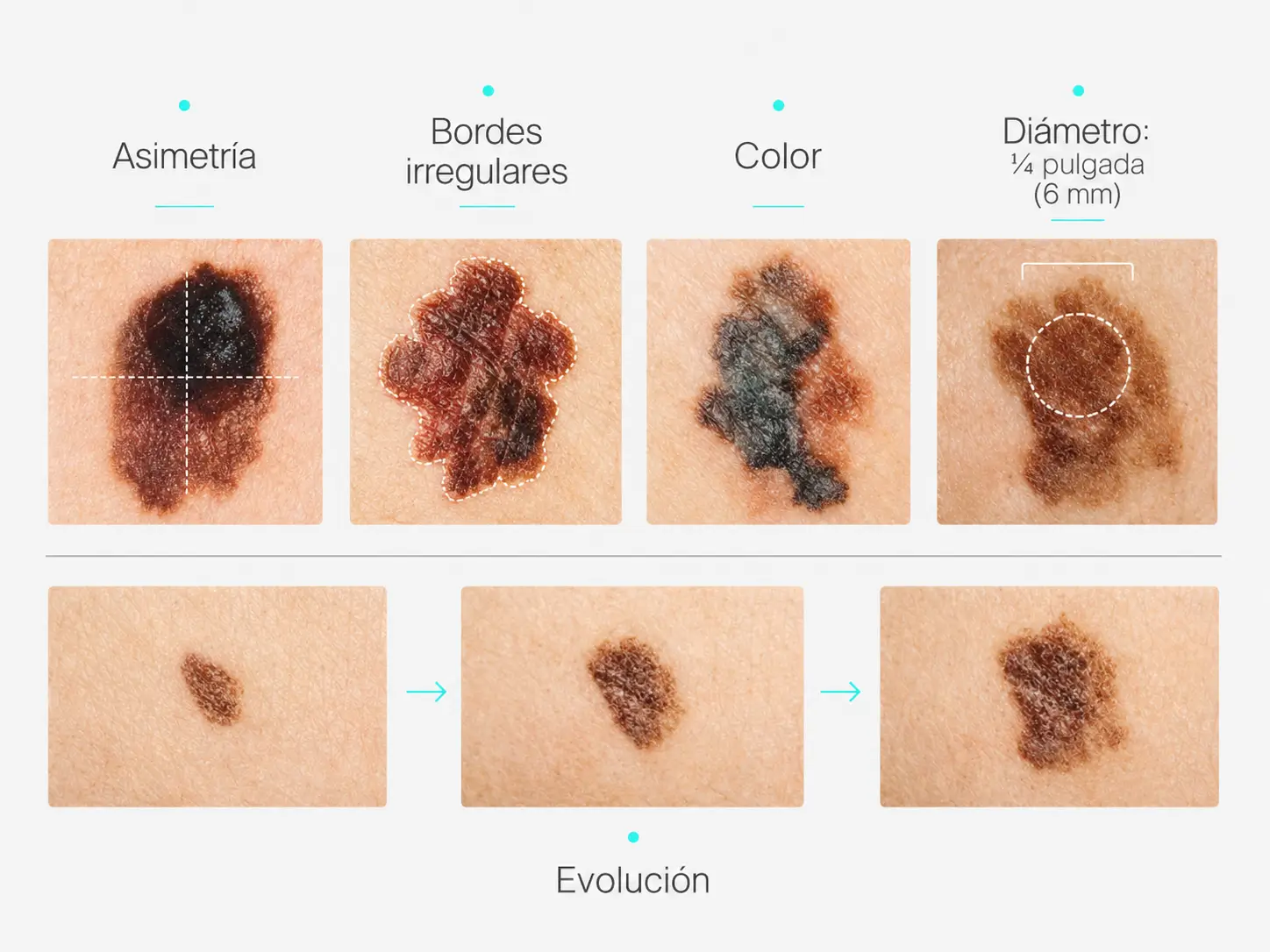 ABCDE del melanoma: asimetría, bordes, color, diámetro y evolución
